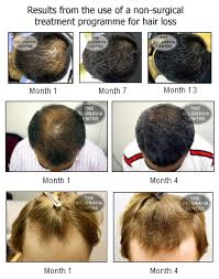If your hair loss is caused by an underlying disease, treatment for that disease will be necessary. Hair Transplant Surgery Follicular Unit Extraction Fue Explained