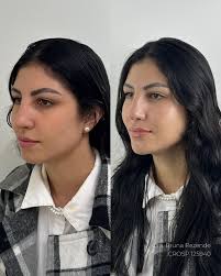 Perfiloplastia realizada, e um resultado inesquecível proporcionado para a  paciente. 😮‍💨🤌🏻 Quer aprender a alcançar resultados como esse? Além de  técnicas de venda, conversão e planejamento estratégico para todo tipo de  caso?