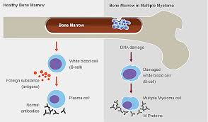 In myeloma, the cells grow too much, crowding out normal cells in the bone marrow that make red blood cells, platelets, and other white blood cells. Multiple Mylemo Treatment Multiple Myeloma Treatment Cost In India Medsurgeindia