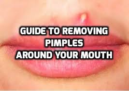 Easy Guide To Remove Pimples Around Mouth How To Remove Pimples Pimples Pimples Under The Skin