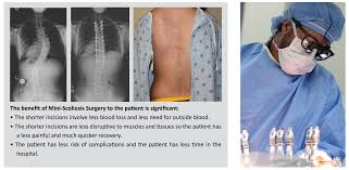 We did not find results for: Minimally Invasive Scoliosis Surgery Texas Spine And Scoliosis