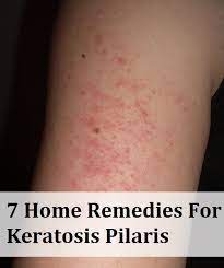 11 Ways To Get Rid Of Keratosis Pilaris For Good Skin Remedies Keratosis Pilaris Skin Treatments