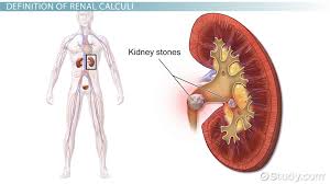 What Are Renal Calculi Definition Causes Symptoms Treatment Video Lesson Transcript Study Com