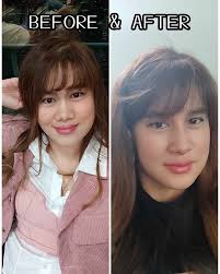 What to expect in rhinoplasty? 1. Your face will definitely change. 2.  People you know will notice the change. 3. The goal is that people who meet  you the 1st time should