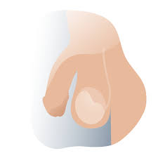 Escrotoplastia: Rejuvenecimiento o lifting escrotal