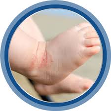 Image result for vyrážka u dětí