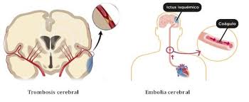 Que Enfermedades Tratan Los Neurologos Sociedade Galega De Neuroloxia
