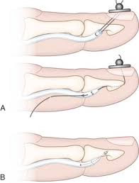 Flexor tendon injuries are common, but recovery of satisfactory function, particularly after injuries within the digital sheath, is sometimes difficult. Closed Avulsion Or Rupture Of Flexor Tendons Plastic Surgery Key
