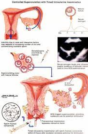 Whether you are trying to conceive on your own or undergoing fertility treatment the two week wait can seem like an eternity. Intra Uterine Insemination Success Rates Risks Uses Iui