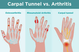 When to seek medical care for carpal tunnel syndrome Carpal Tunnel Syndrome Vs Arthritis What S The Difference