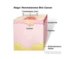 It affects both men and there is no cure for xeroderma pigmentosum, so treatment focuses on any problems that are. Xeroderma Pigmentosum Medlineplus Genetics