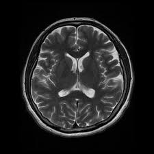 Now third is in inner ear problems, now in inner problems again we need to know what are the different types of inner ear problems which can cause tinnitus. Vestibulocochlear Neuritis Radiology Case Radiopaedia Org