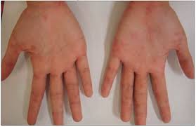 Image result for scabies human children