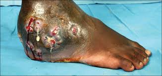 The term foot fungus describes superficial fungal infections of the foot. References In Mycetoma A Unique Neglected Tropical Disease The Lancet Infectious Diseases