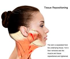 Face Lift Facelift Face Lift