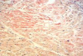 Amyloidosis is a condition that causes an abnormal protein called amyloid to build up in your body. Cardiac Amyloidosis A Comprehensive Review Sciencedirect