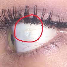 Netzhaut Lost Sich Ab Augen Gesicht Augapfel
