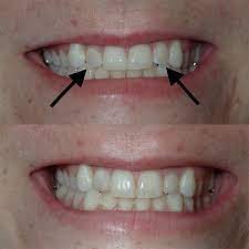 There are pros and cons to brightening up at the dentist's office or with gel strips. Dental Implants In Louisville Ky Dentist 40243