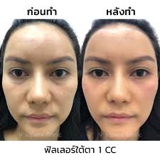 รีวิว ฉีด ฟิ ล เลอ ร์ เ ก ริ