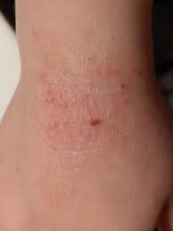 Image result for dermatitis contacta allergica