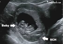 The Day I Bled And Thought I Lost My Baby Huffpost Life