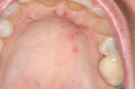 Image result for oral herpes symptoms roof of the mouth