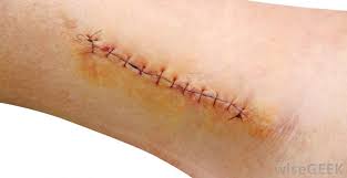 Sometimes, your doctor may recommend the use of an antibiotic ointment like bacitracin or neosporin to help minimize infection. How Do I Treat A Leg Wound With Pictures