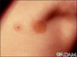 Image result for Urticaria pigmentosa children