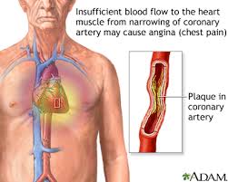 If a nerve in this area is pinched, irritated, or injured, you may also feel pain in other places where the nerve travels, such as your arms, legs, chest, and. Stable Angina Medlineplus Medical Encyclopedia