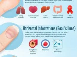 13 Health Issues Your Fingernails Warn You About The Whoot Fingernail Health Nail Health Health Remedies