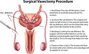 Image result for Vasectomy