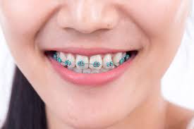 If you got your braces off and you do have stains on your teeth, some dental professionals recommend waiting 6 months before you whiten make sure you visit your dentist for a good cleaning right after you get your braces off. The Purpose Of Elastic Ligatures On Braces
