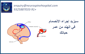 سيزيد إجراء الانصمام في الهند من عمر حياتك catheter life hospital