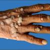 Abstract tuberculosis verrucosa cutis (tvc) also known as prosector's wart occurs due to exogenous inoculation of tubercle bacilli into the skin. 1