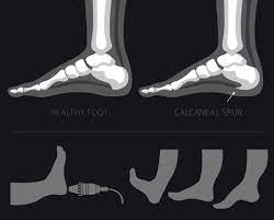 Heel Spur Treatment Painful Bone Bottom Of Heel - Moore Foot & Ankle