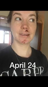 What is the best product for healing and scarring above lip after stitches  removal?