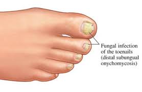 toenail fungus symptoms fungal