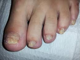 Toenail fungus, also called onychomycosis, is a disease caused by a group of fungus called dermatophytes that gets beneath the nails and takes root. Nail Fungus And How To Treat It Naturally With Home Remedies