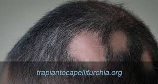 Perdita dei capelli, quali possono essere le cause? Alopecia Areata Perdita Dei Capelli A Chiazze E Trapianto Di Capelli Trapianto Capelli Turchia