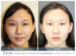 Considering plastic surgery in the bay area? Asian Non Surgical Innovations Before And After 01 Sistine Facial Plastic Surgery