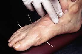 Acupuncture Dry Needling For Chiropodists Learn Acupuncture From Meridian Health Education