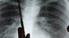 Mein sohn (19wochen alt) hat seit zwei wochen sauer riechenden stuhlgang.seit dem habe ich auch mit zufüttern angefangen, weiß aber nicht ob dass damit zusammenhängt.???was meint ihr? Krebs Fruherkennung Der Geruch Des Tumors Gesundheit Sz De