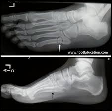 Use the video or information below to you may walk on the foot as comfort allows but you may find it easier to walk on your heel in the early stages. Metatarsal Fractures Orthopaedia