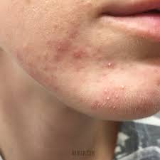 Image result for folliculitis symptoms