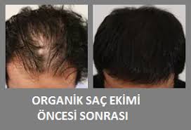 Organik Sac Ekimi Nedir Nasil Yapilir Fiyatlari Hakkinda Bilgi Sac Ekimi Destek