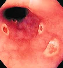 38 year old woman with esophagus ulcer; Infections Of The Luminal Digestive Tract Clinical Gate