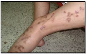 Image result for Neurotic Excoriation