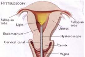 Hysteroscopy Princeton Ivf