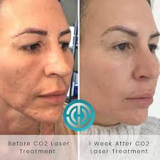 Candela Medical UK & Ireland