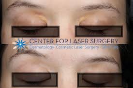 Image result for xanthelasma of eyelid